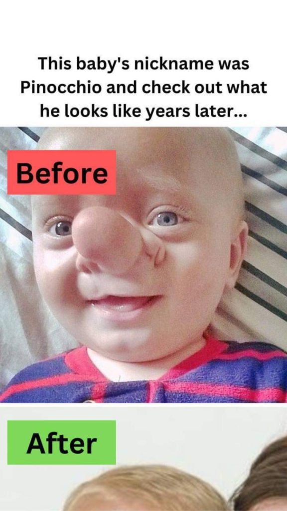 ST.This baby’s nickname was Pinocchio and check out what he looks like years later…
